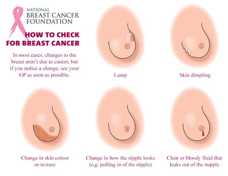 Kanser payudara tahap 4